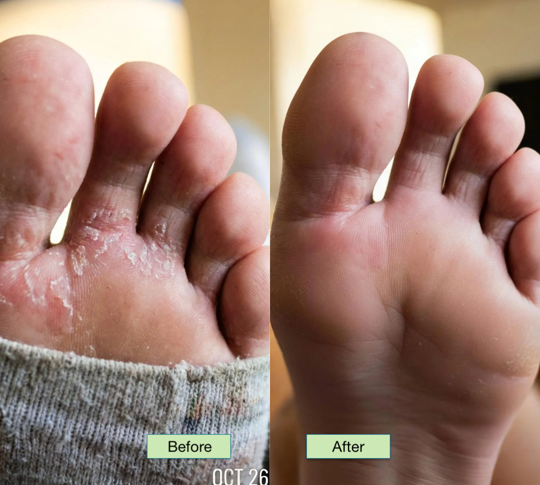 The Athlete’s Foot Recovery Bundle