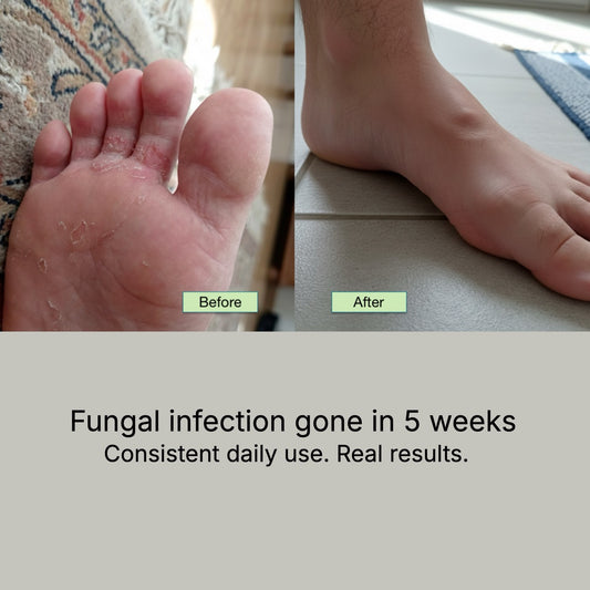 The Athlete’s Foot Recovery Bundle