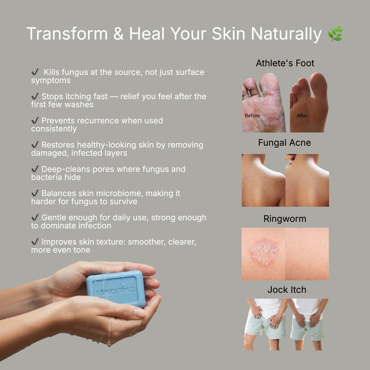 Sanidermis AntiFungal Relief Soap Bar